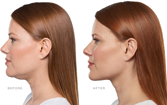 Everything You Ever Intended to Know About Kybella