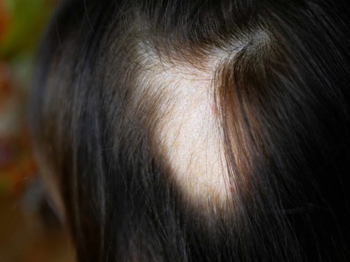 Everything You’ve Ever Wanted to Know About Getting a Hair Transplant
