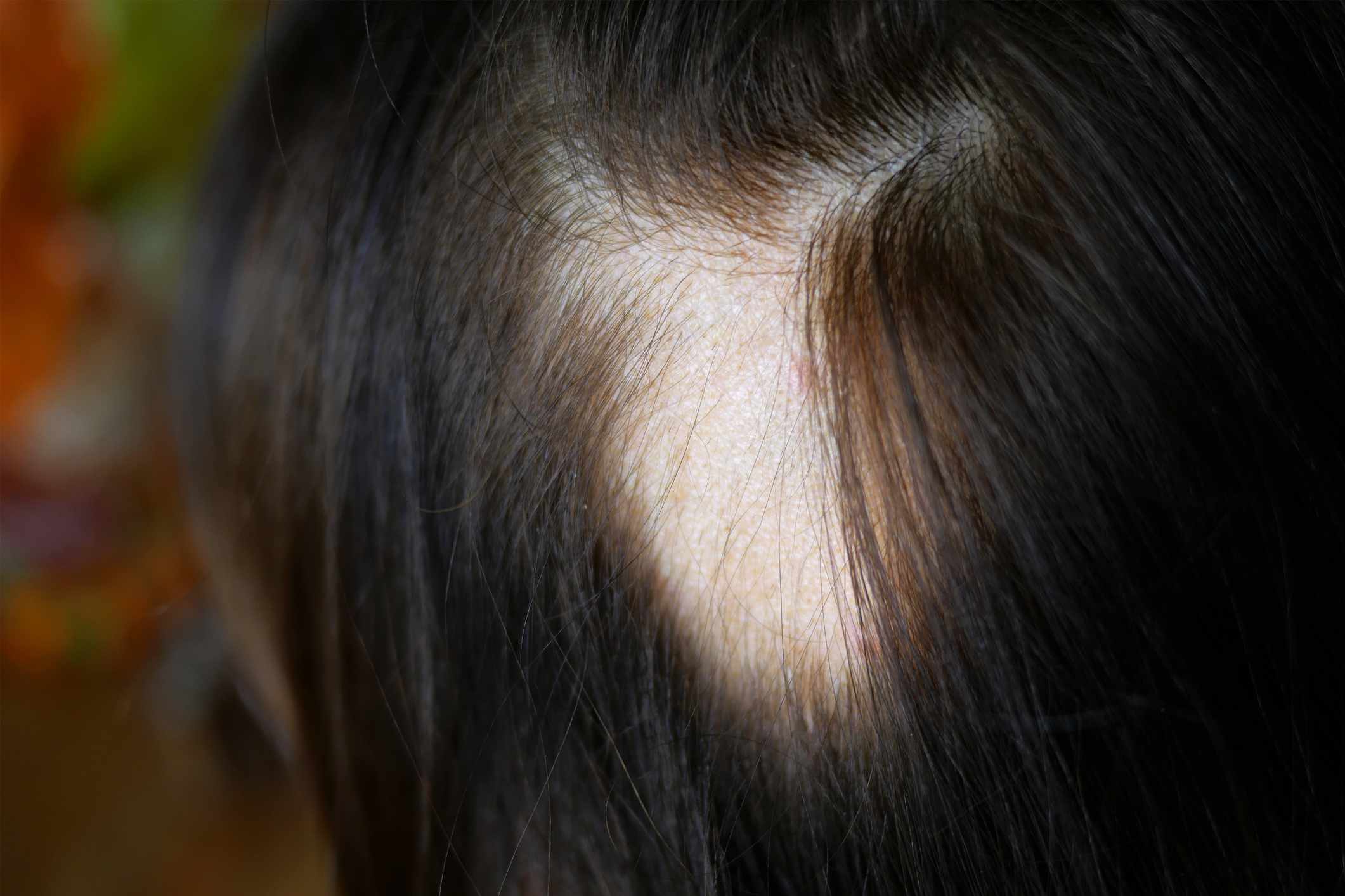 - Latest Fashion & Lifestyle Trends how much does a hair transplant cost