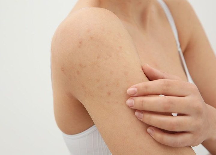 How to Avoid & Treat Pimples After Waxing