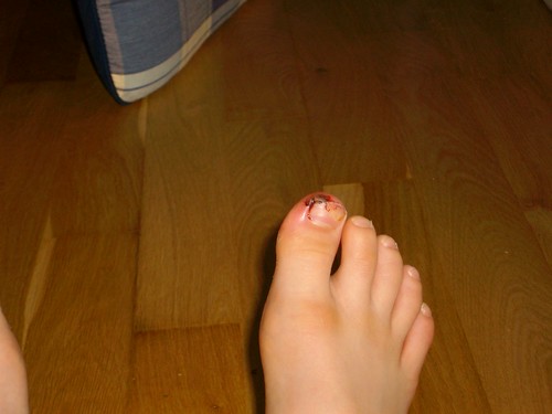 stubbed toe