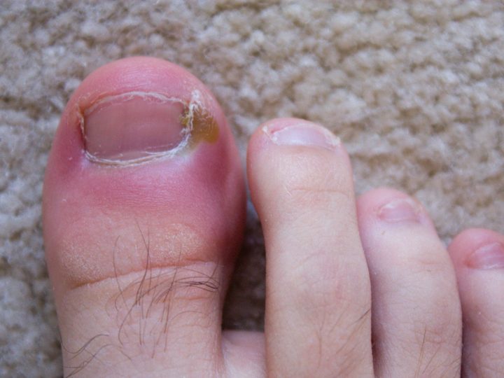 Ingrown Toenail: Removal, Treatment And More
