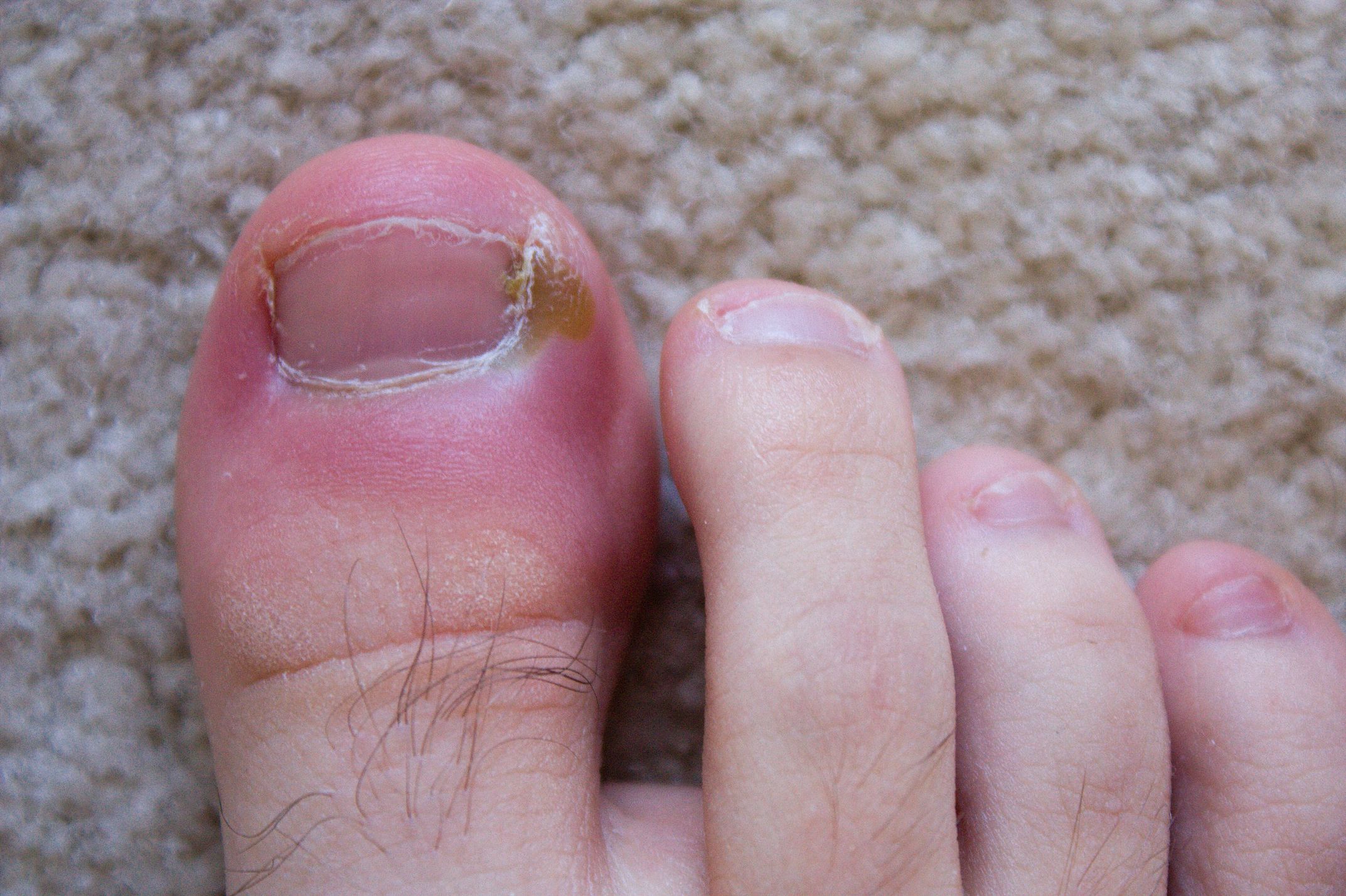 Paronychia_green_discolor - Latest Fashion & Lifestyle Trends Ingrown Toenail