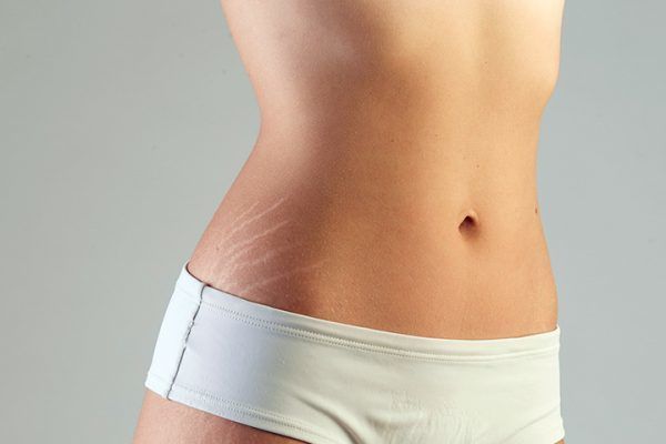 Amazing Natural Remedies For Stretch Marks That You Must Try