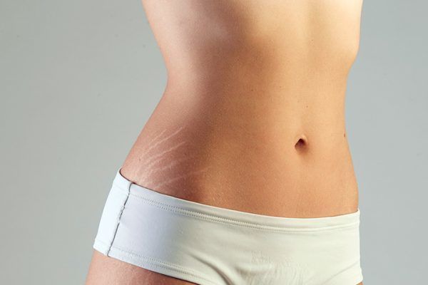 natural remedies for stretch marks