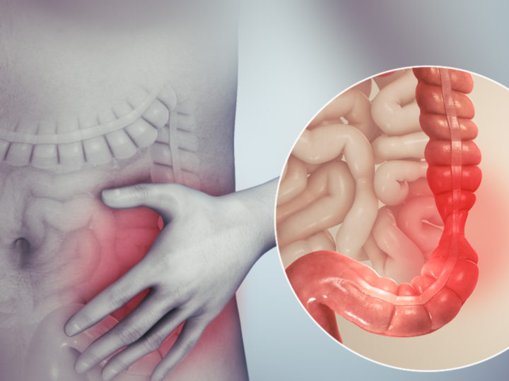 What is irritable bowel syndrome Causes and Treatment