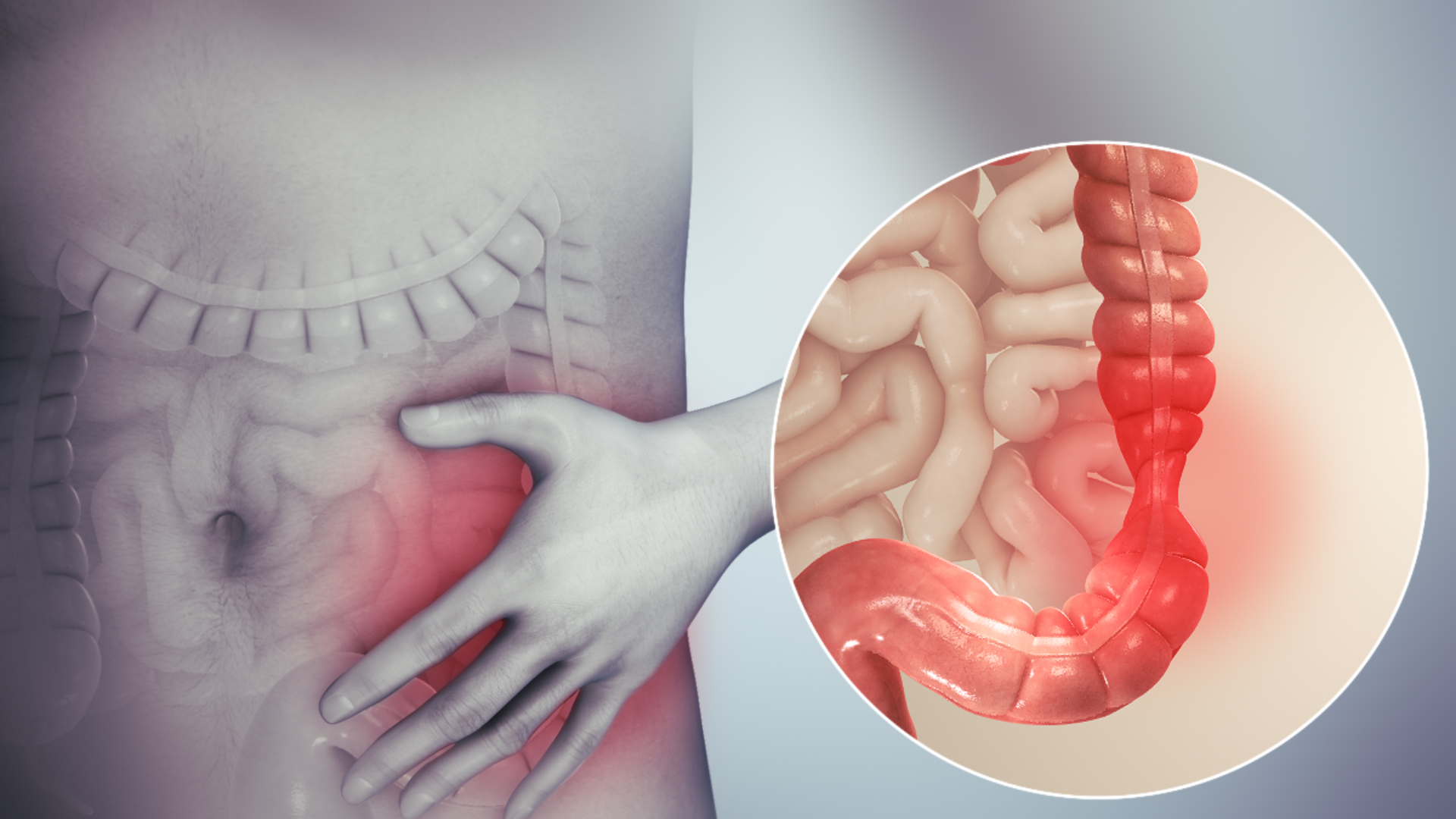 Irritable_bowel_syndrome - Latest Fashion & Lifestyle Trends