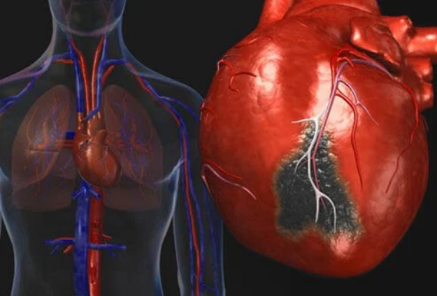 Heart Disease Causes and Prevention