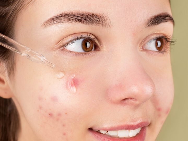 Is Hyaluronic Acid Good For Acne?