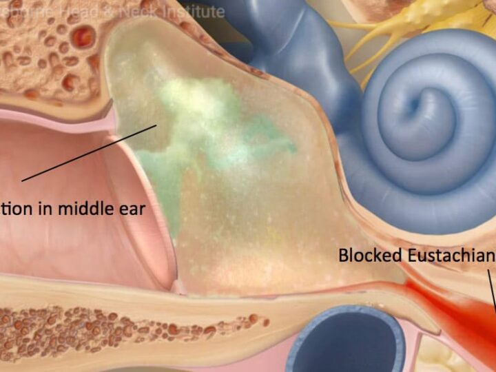Eustachian Tubes Dysfunction – Everything You Need to Know