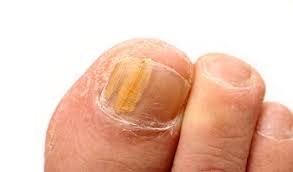 Toenail Fungus Treatment